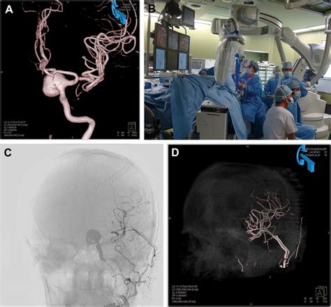 Combined Surgical And Endovascular Treatment Of Complex Cerebrovascular