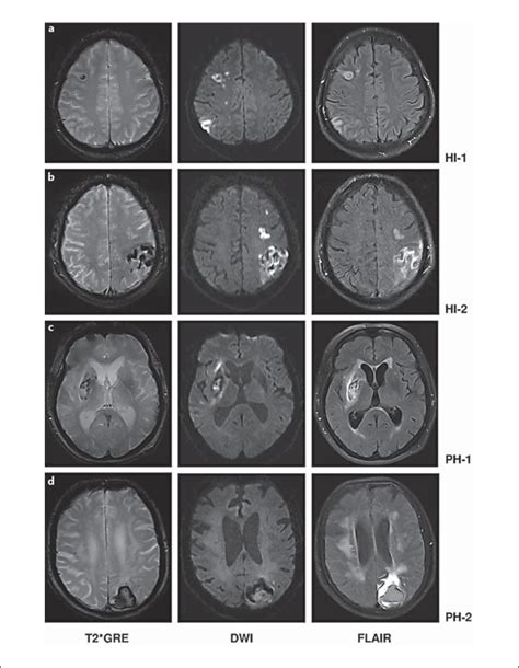 Examples Of Different Types Of HT In MRI In T2 GRE DWI And FLAIR