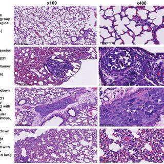 Cse Knockdown Inhibits Human Breast Cancer Metastasis In Nude Mice