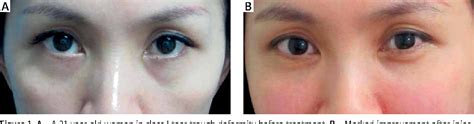 Figure 1 From Tear Trough Deformity Different Types Of Anatomy And