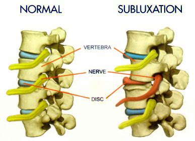 Vertebral Subluxation Treatment - Snyder Chiropractic & Wellness