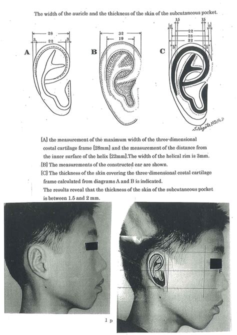 Accuracy Evaluation On Proportions Of The Reconstructed Auricle