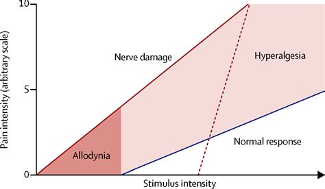 Allodynia And Hyperalgesia In Neuropathic Pain Clinical Manifestations