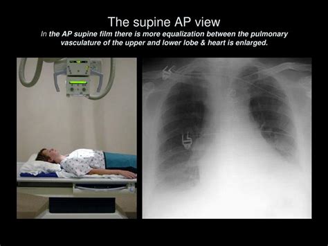 Ppt The Complete Idiot’s Guide To Reading The X Ray Powerpoint Presentation Id 583063