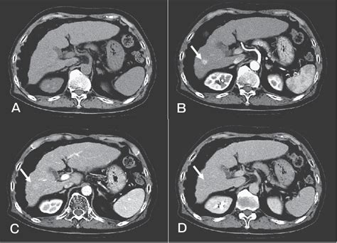 Figure 2 From A Case Of Dual Pathology Hepatocellular Carcinoma Hcc And Cholangiolocellular