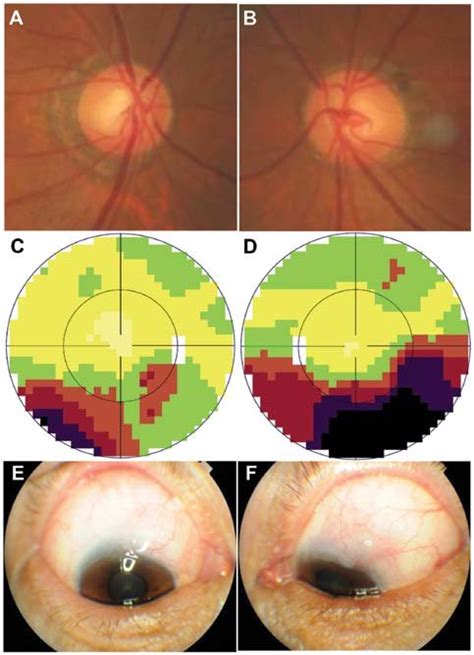 Images Were Obtained From One Primary Open Angle Glaucoma Poag Download Scientific Diagram