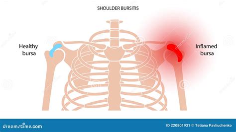 Bursitis Inflammation Concept Stock Vector Illustration Of Bone