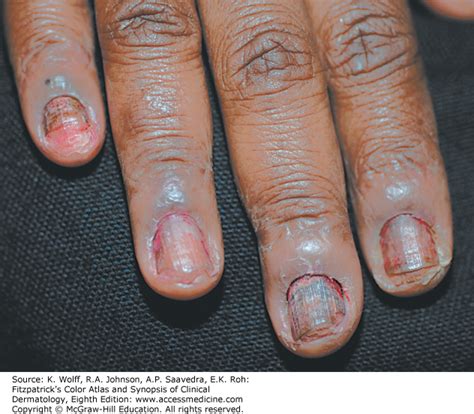 Pseudomonas Nail Infection Bios Pics