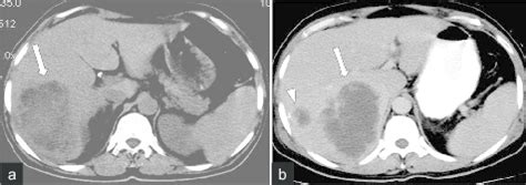 Amebic Liver Abscess A Non Contrast And B Contrast Enhanced Ct Scan