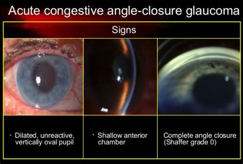 Acute Closed Angle Glaucoma Risk Factors Symptoms And Treatment