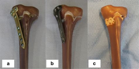 Biomechanical Properties Of Five Different Currently Used Implants For