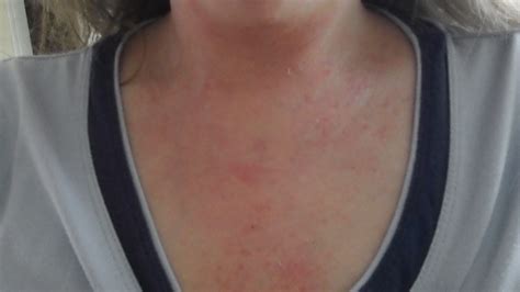 Neck And Chest Rash Pictures Photos