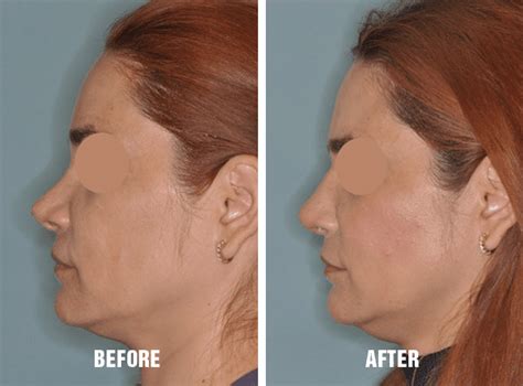 Repairing The Scooped Nose Dr Anthony Bared