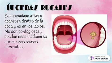 LAS ENFERMEDADES BUCALES MÁS COMUNES YouTube