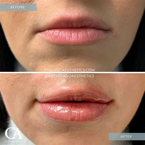 Lip Injections Before After Chicago Aesthetics Medspa