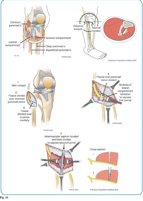 Figure From Functional Problems And Arthrofibrosis Following Total