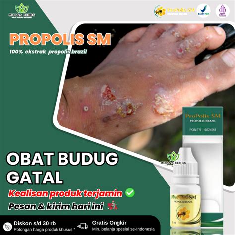 Jual Obat Budug Kulit Gatal Budug Di Kaki Budug Santri Budug Bernanah