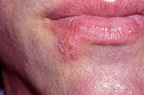 Hiv Sores On Lips