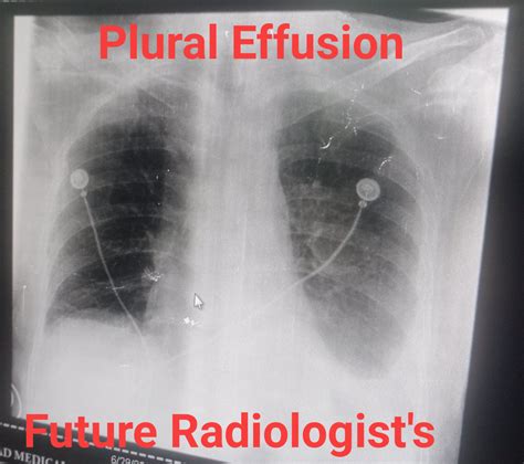 Dr. Radiology - Plural Effusion . A pleural effusion...
