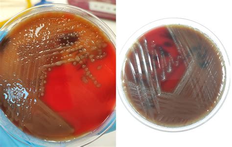 Enfermedad Invasora Por S Pneumoniae Sochinf