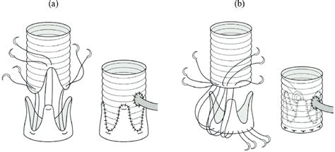 Schema of valve-sparing aortic root repair. (a) Remodeling and (b ...