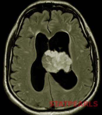 Figure Choroid Plexus Papilloma Image Courtesy S Bhimji Md