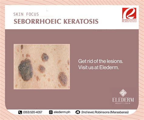 Elederm - Seborrhoiec keratosis or seborrhoeic warts are...