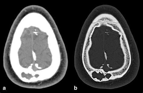 Spectrum Of Lytic Lesions Of The Skull A Pictorial Essay Springerlink