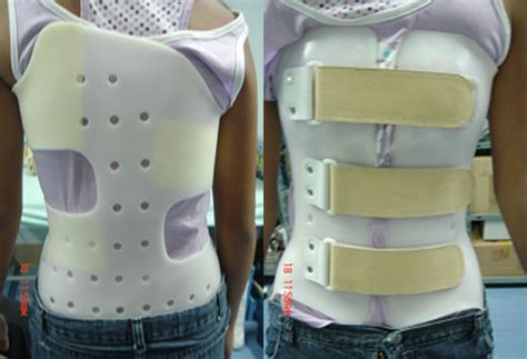 scoliosis brace   adolescent idiopathic scoliosis