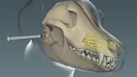 Maxillary Nerve Block