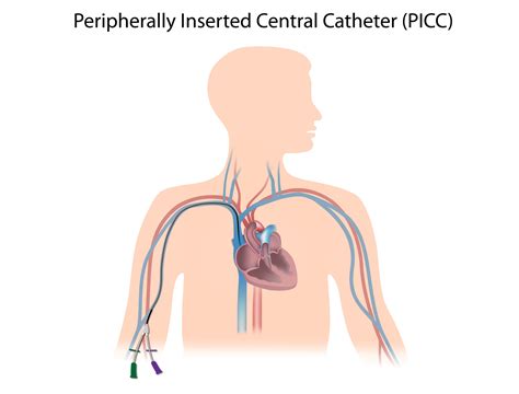 Central Line Insertion — From New to ICU