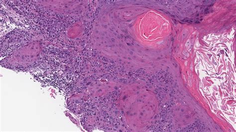 Squamous Cell Carcinoma Of The Larynx Ottawa Atlas Of Pathology