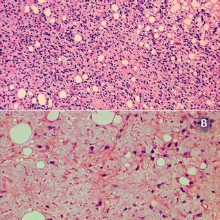 Dedifferentiated Liposarcoma A Dense Highly Pleomorphic Sarcomatoid