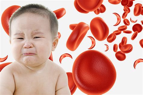 Sickle Cell Anemia Causes Diagnosis Symptoms Treatment And Perspective Scope Heal