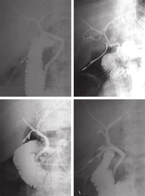 Representative Cholangiograms Showing Variations In The Anatomy Of The