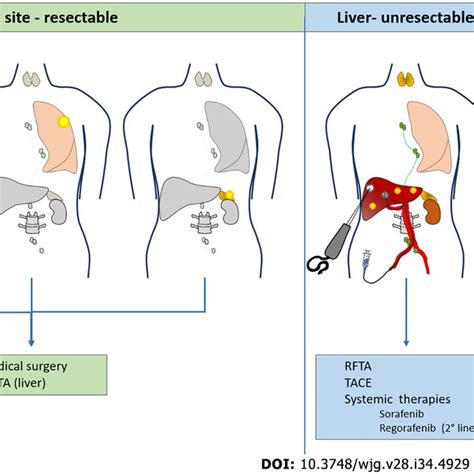 Hepatocellular Carcinoma Recurrence After Liver Transplantation