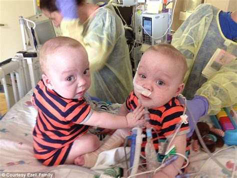 Conjoined Twins Separated In Dallas Are Released From Hospital Daily Mail Online