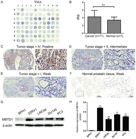 Overexpression Of Mbtd In Pca Tissues And Cell Lines A Ihc Staining