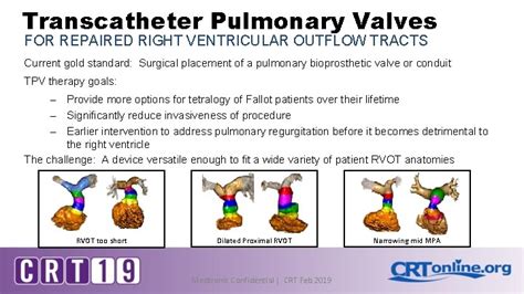 Medtronic Harmony Transcatheter Pulmonary Valve System The First