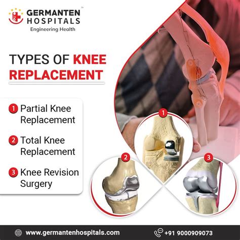 Pin on Best Knee Replacement Surgery in Hyderabad