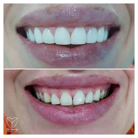 Composite Veneers In Dubai Best Veneers In Dubai