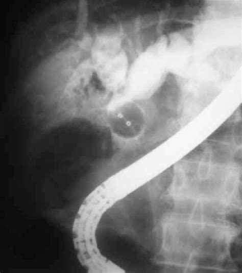 Ercp Balloon Cholangiogram Shows Complex Hilar Strictures With Download Scientific Diagram