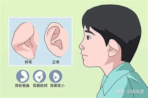 先天耳畸形高发需尽早干预，手术矫正“杯状耳”还孩子正常外观 知乎