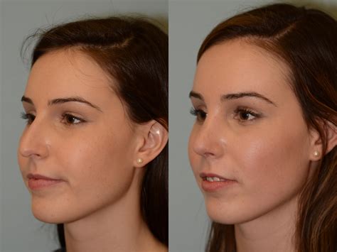 Rhinoplasty Houston Tx Before And After Photos Gallery 28484