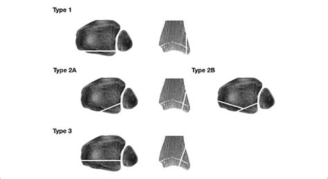 Posterior Malleolar Fractures Ankleinfo