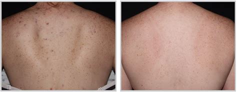 Sciton Forerver Clear Bbl Rochester Laser Treatment Rochester