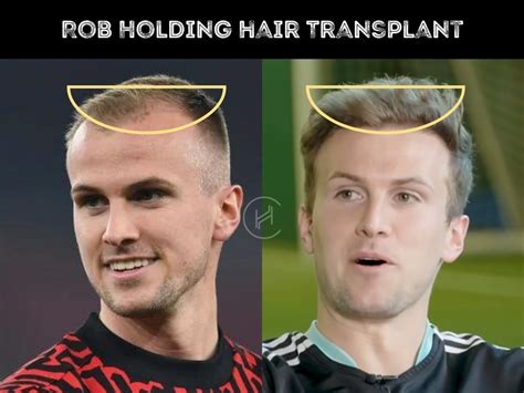 Rob Holding Hair Transplant - Hair Loss & Technical Analysis