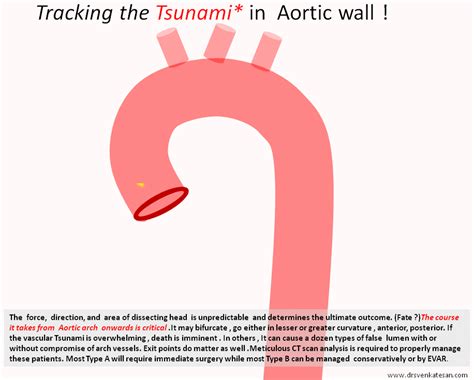 Aortic Dissection Drsvenkatesan Md