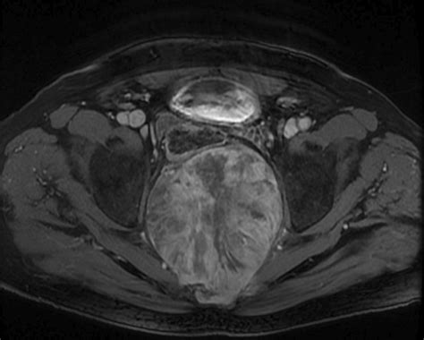 Magnetic Resonance Imaging Of The Pelvis Showed A Large Midline