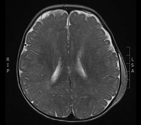 Subgaleal Hematoma In Adults